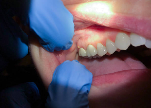 Best Emergency Dental Care for Broken or Chipped Teeth in Monte Sereno, CA